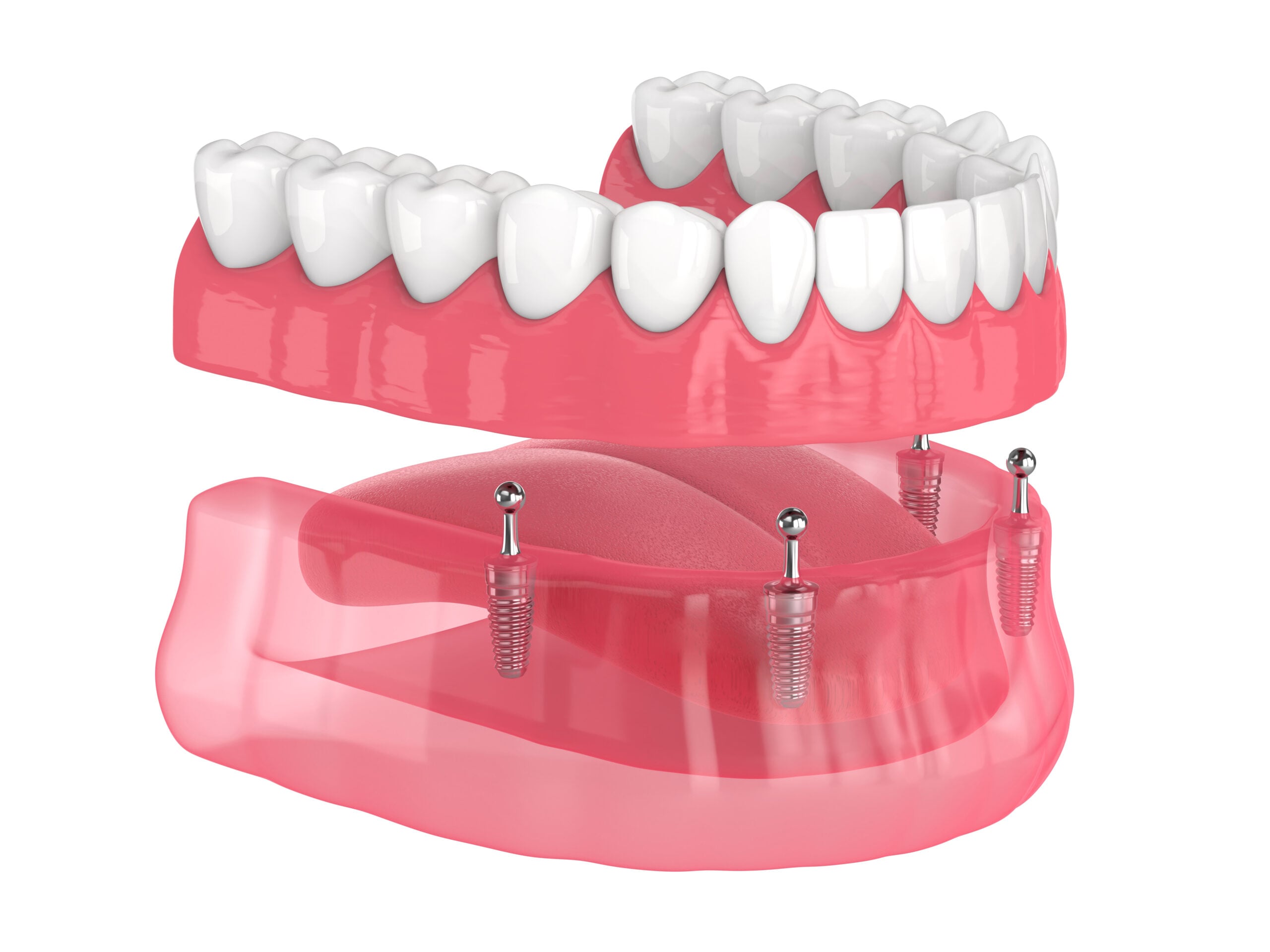 HOME 8 ILLUSTRATION OF A FULL ARCH SUPPORTED BY DENTAL IMPLANTS