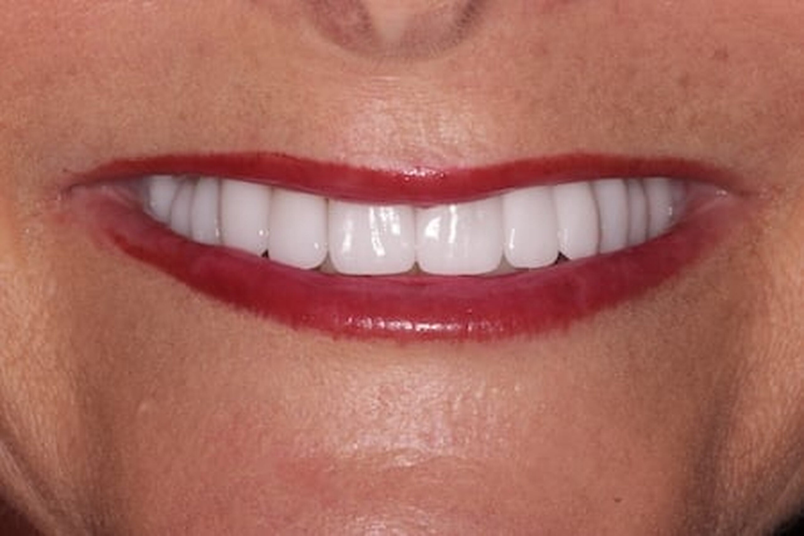 NO-PREP VENEERS 8 AFTER 215525 HIGH RESOLUTION SCALED