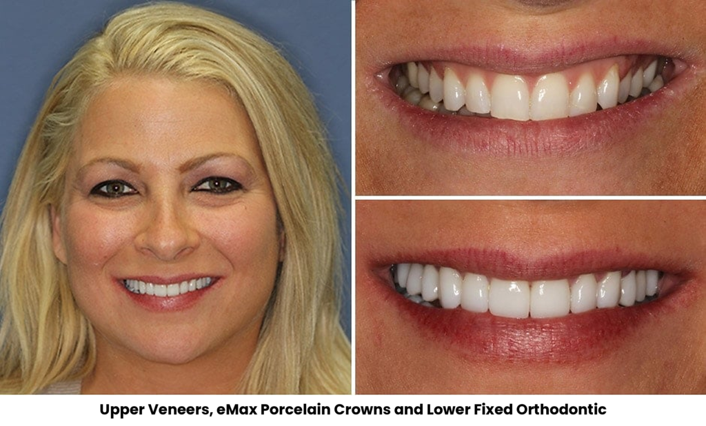 TOP 12 UPPER VENEERS EMAX ORTHODONTIC