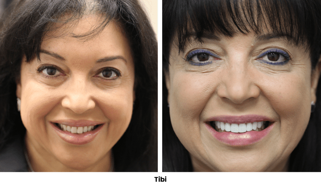 TOP 32 TIBI