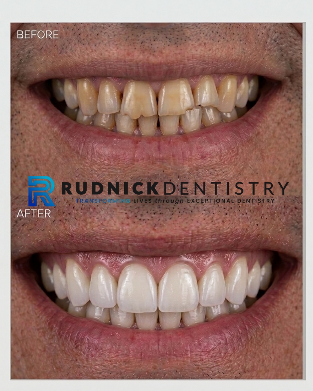NO-PREP VENEERS 4 BEFORE AND AFTER NO PREP VENEERS BY DR. ANDREW RUDNICK